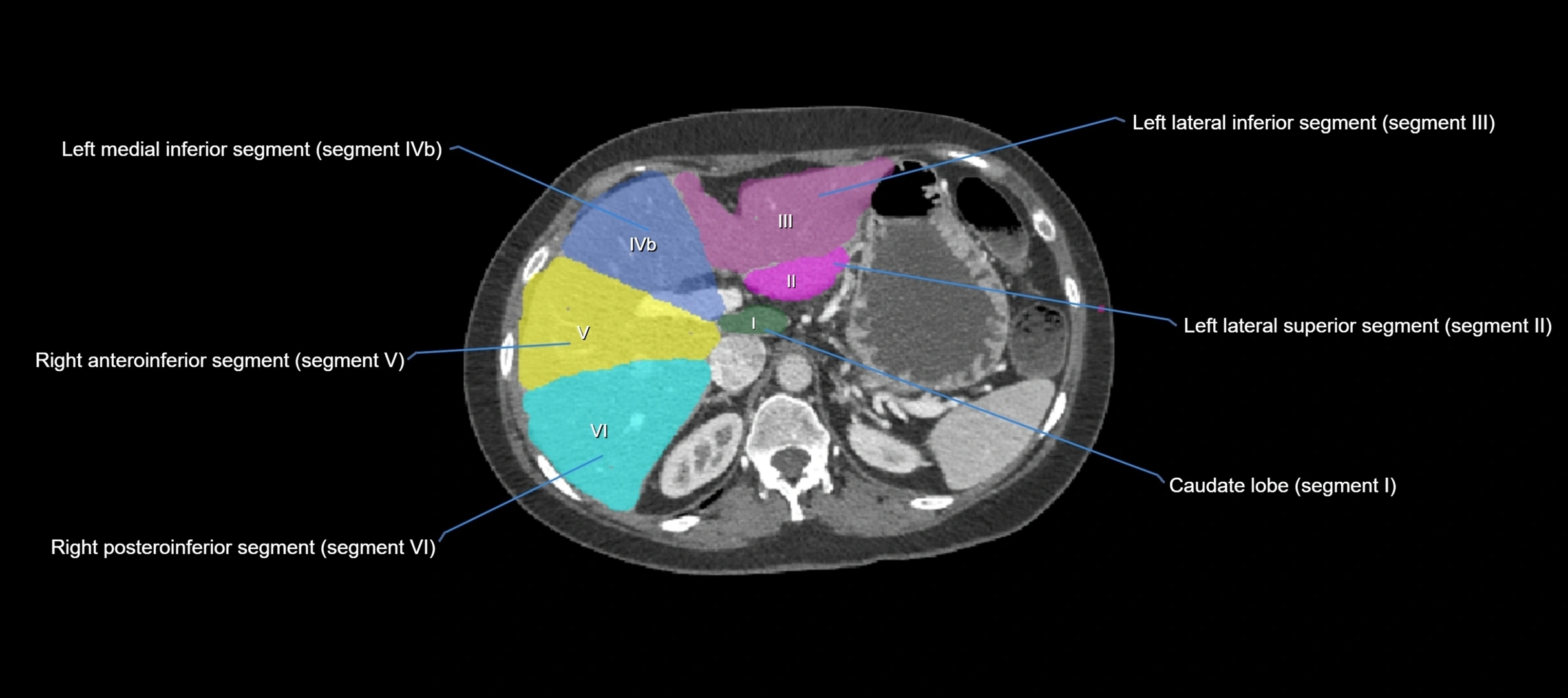 CT liver segments axial cross sectional anatomy labelled image-00047.webp